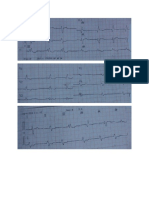 EKG OMI