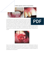 Periodontitis Apical Crónica Supurativa