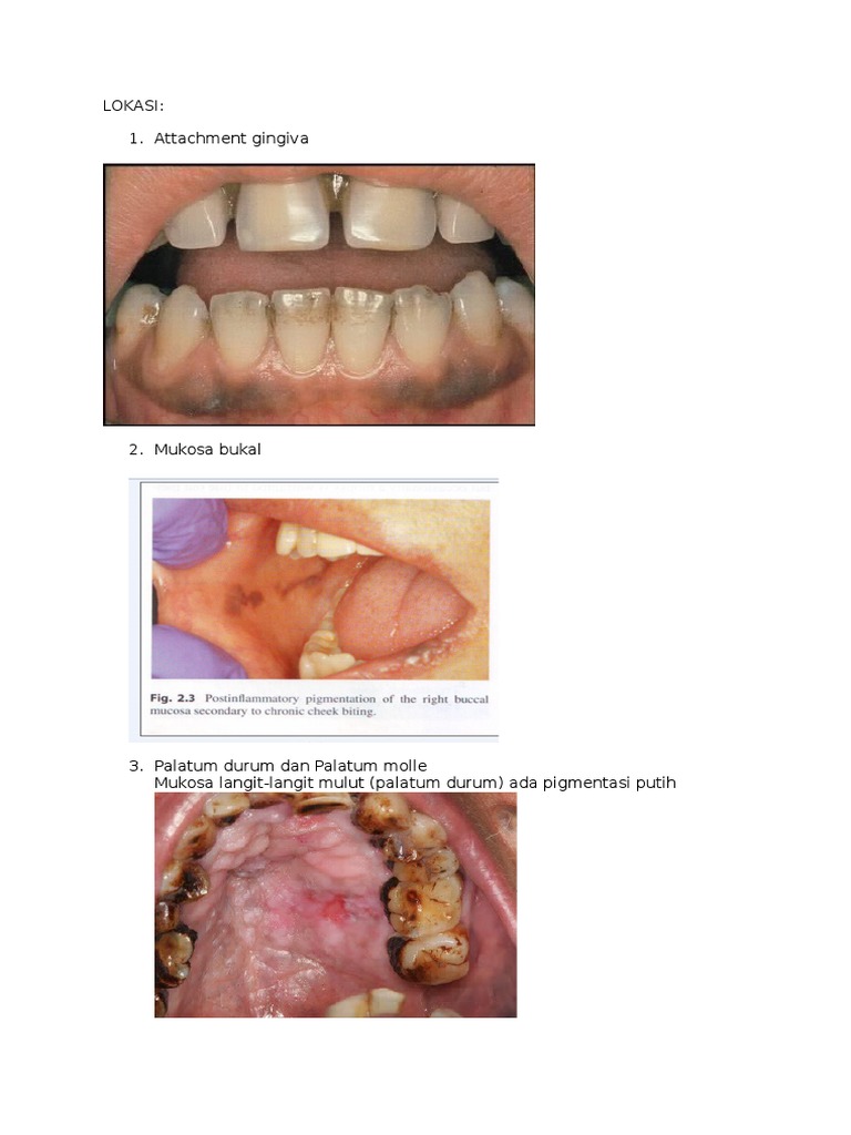Smoker's Melanosis PDF