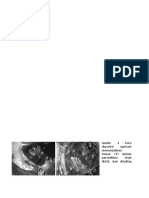 Meningioma Intraparenkimal Pada Anak Page 2-3