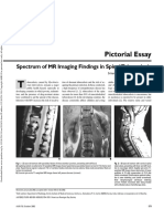 Pictorial Essay: Spectrum of MR Imaging Findings in Spinal Tuberculosis