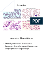 Anemias Hemoliticas