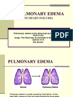 Pulmonary Edema