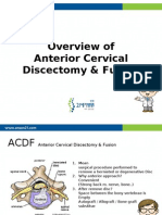 Overview of Anterior Cervical Discectomy & Fusion