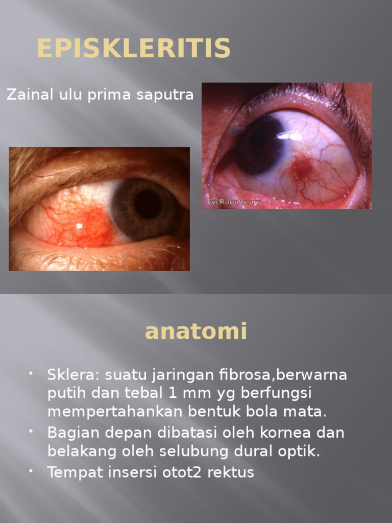 episkleritis