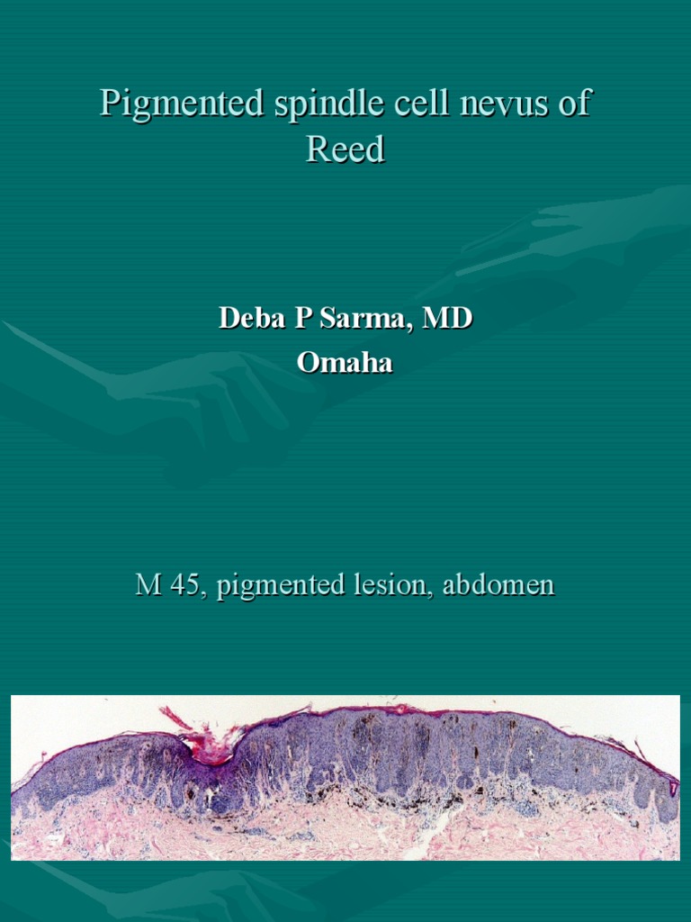 Pigmented Spindle Cell Nevus of Reed (Pigmented Epitheliod Compond