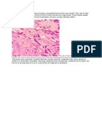 Neurilemmomas Dx