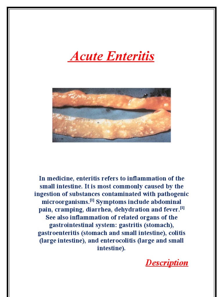 Acute Enteritis PDF Gastrointestinal Tract Radiation Therapy