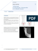6 12 II Fractures of The Thumb Nonoperative Treatment of A Rolando Fracture