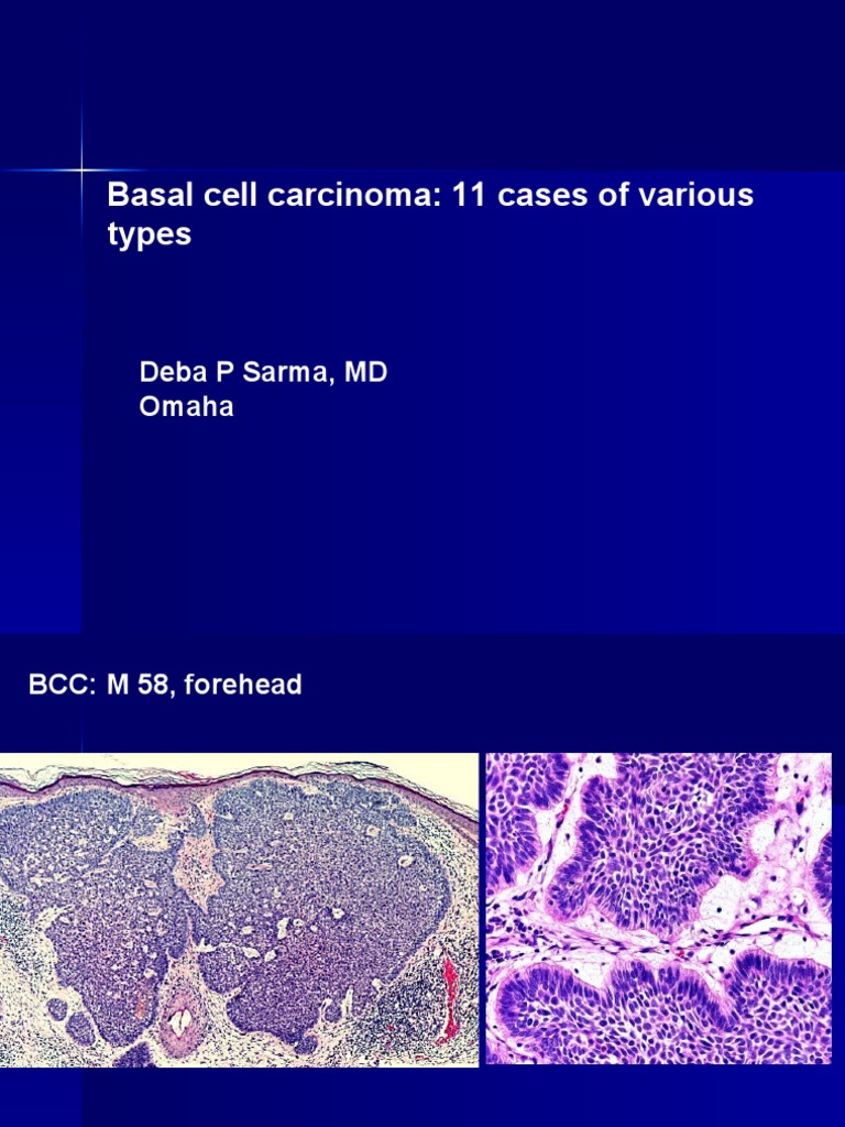 Types of Basal Cell Carcinoma Cases | PDF | Carcinoma | Epidermis