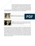 Mediastinal Mass