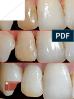 Clareamento de dente desvitalizado