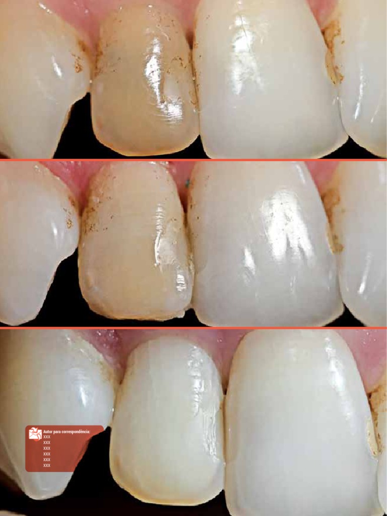 clareamento-de-dente-desvitalizado-pdf-boca-qu-mica