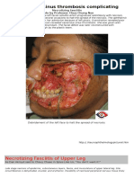 Cavernous Sinus Thrombosis Complicating