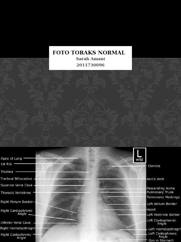 Radiologi Toraks | PDF