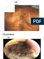 Pitriasis Versikolor