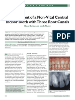 Management of A Non-Vital Central Incisor Tooth With Three Root Canals