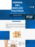 Hernia Del Nucleo Pulposo