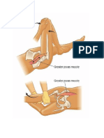 Psoas Sign