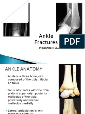 Ankle Fracture Ankle Musculoskeletal System Ankle Fracture Ankle Musculoskeletal System