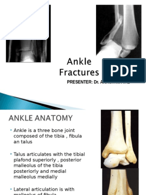 Ankle Fracture Ankle Musculoskeletal System