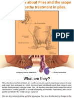 Facts to Know About Piles and the Scope of Homeopathy Treatment in Piles.