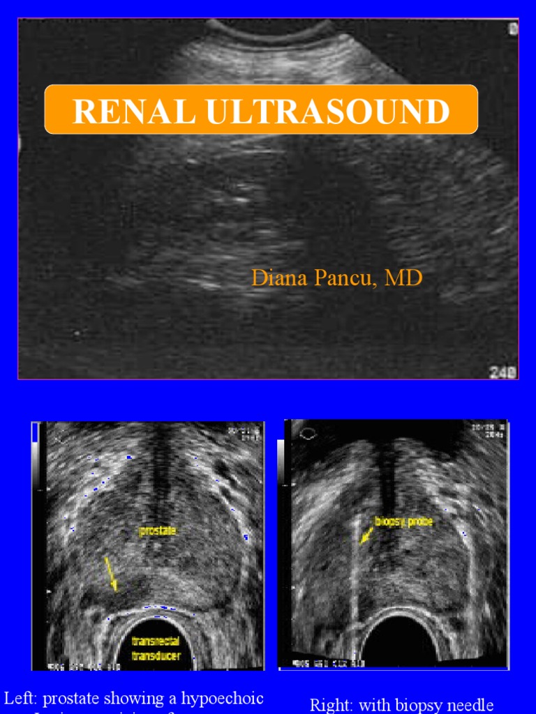 Renal Ultrasound: Diana Pancu, MD | PDF | Kidney | Adrenal Gland