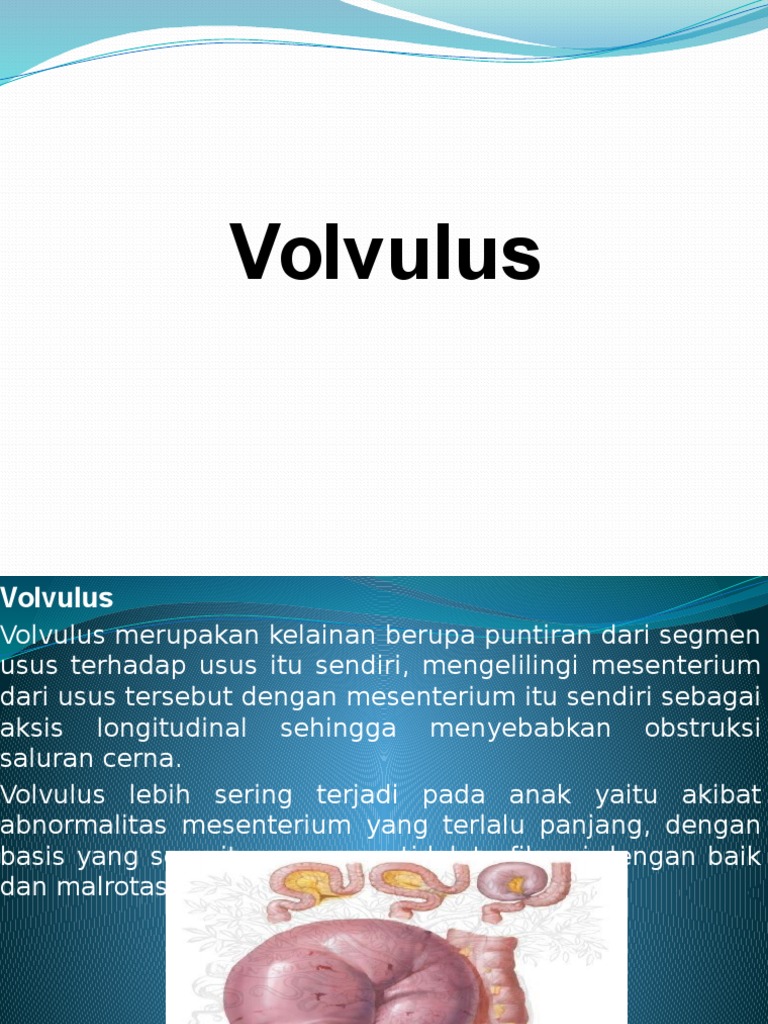 Volvulus | PDF | Sains & Matematika
