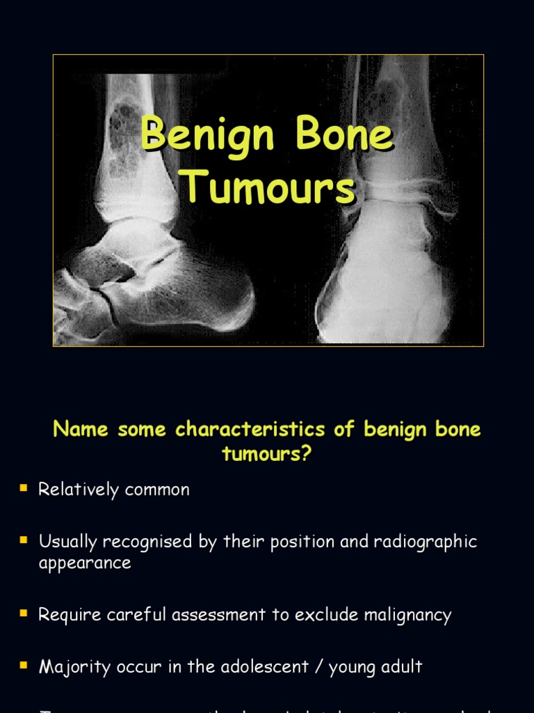 Overview of Benign Bone Tumors | PDF | Bone | Neoplasms