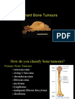 Malignant Bone Tumours