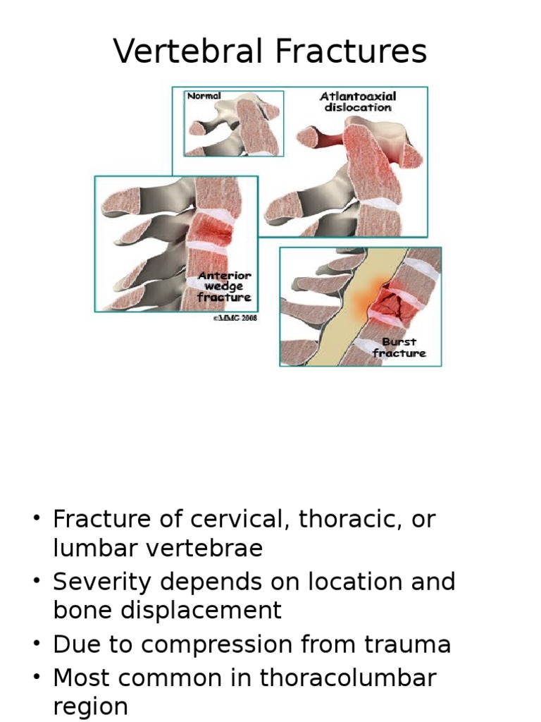 Vertebral Fractures | Vertebra | Vertebral Column