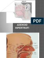 Adenoid Hipertrofi Siti
