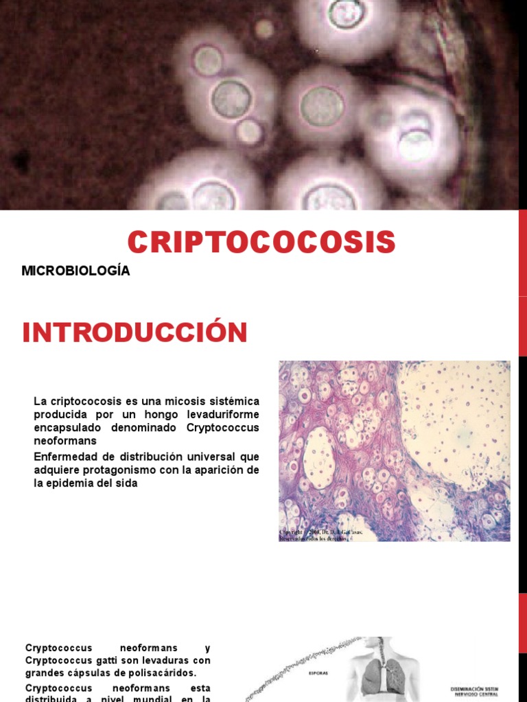 CriptoCocosIs | Patologia clinica | Infección