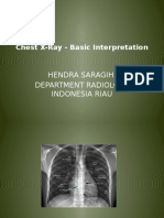 Chest X-Ray - Basic Interpretation