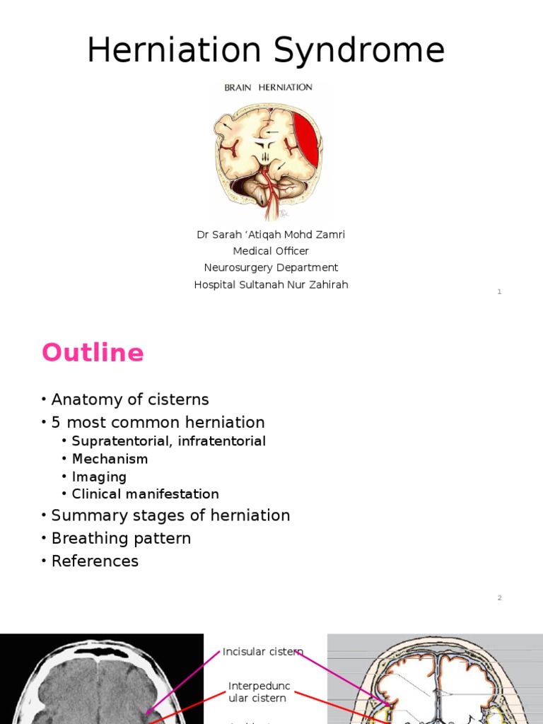 Brain Herniation Syndrome Brain Neuroanatomy
