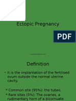 Ectopic Pregnancy7