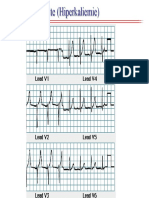 EKG