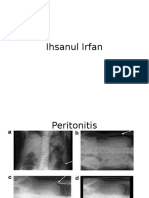 Radiologi Peritonitis Dan Perforasi Ihsan