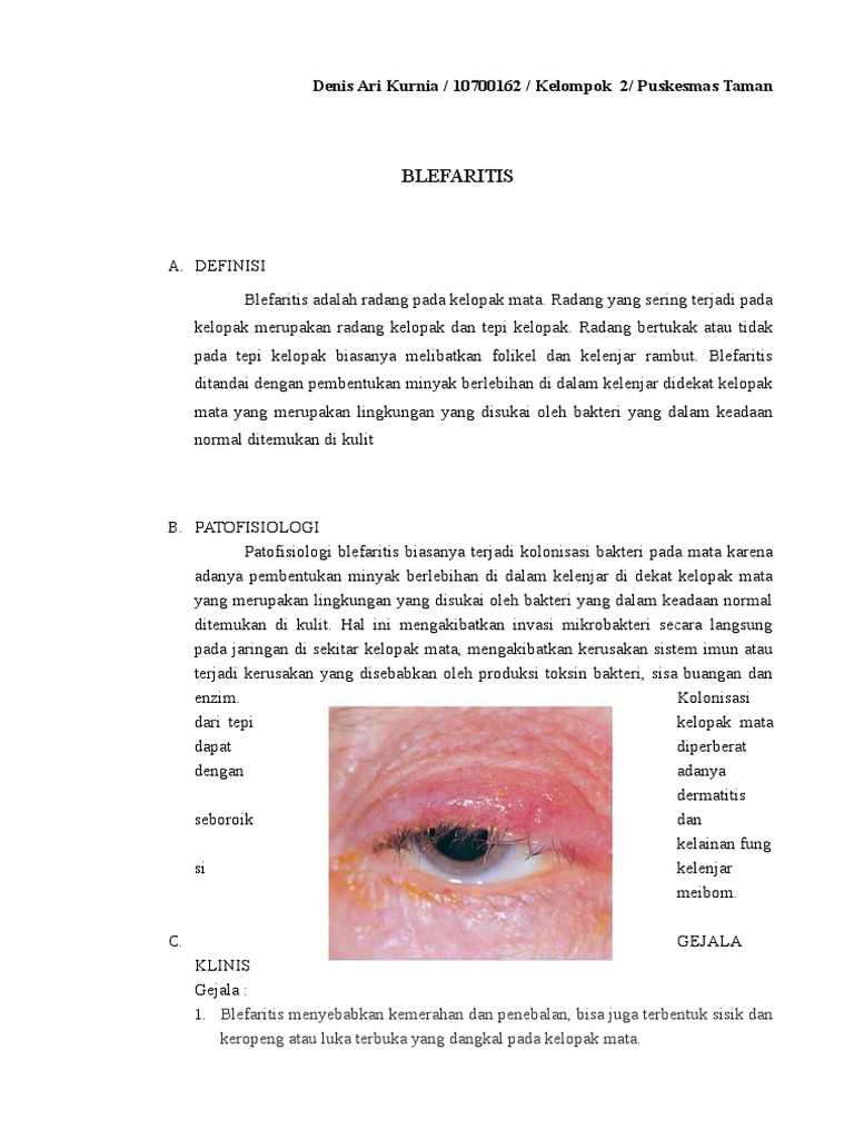 Gejala dan Penanganan Blefaritis | PDF