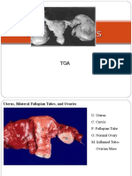 Tubo Ovarian Abcess