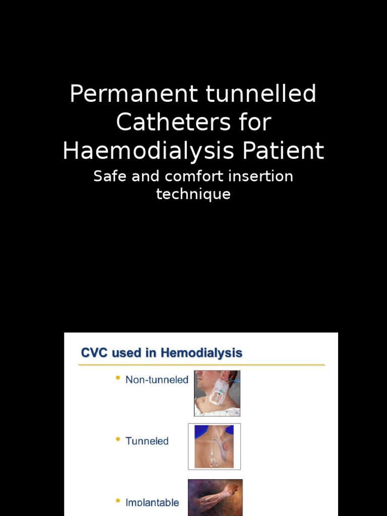 Permanent Tunnel Catheter PDF Intravenous Therapy Medical Equipment