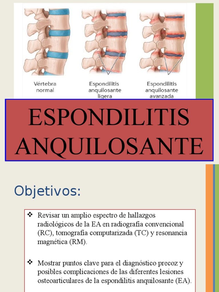 Espondilitis Anquilosante Imagenología | PDF | La columna vertebral ...