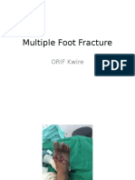Multiple Foot Fracture Orif Kwire