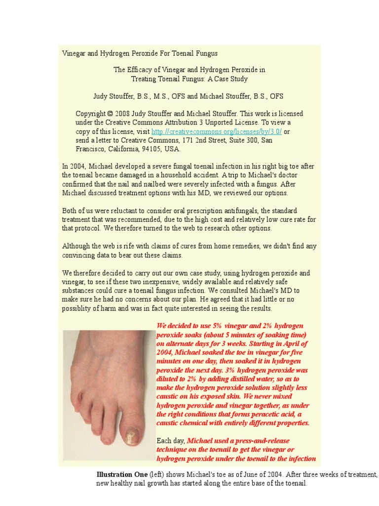 Vinegar and Hydrogen Peroxide For Toenail Fungus PDF Vinegar Nail (Anatomy)