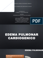 Edema Pulmonar de Tipo Cardiogenico