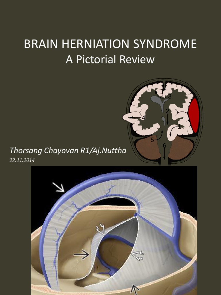 Brain Herniation | PDF | Nervous System | Organ (Anatomy)