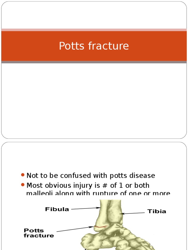 Potts Fracture Ankle Knee