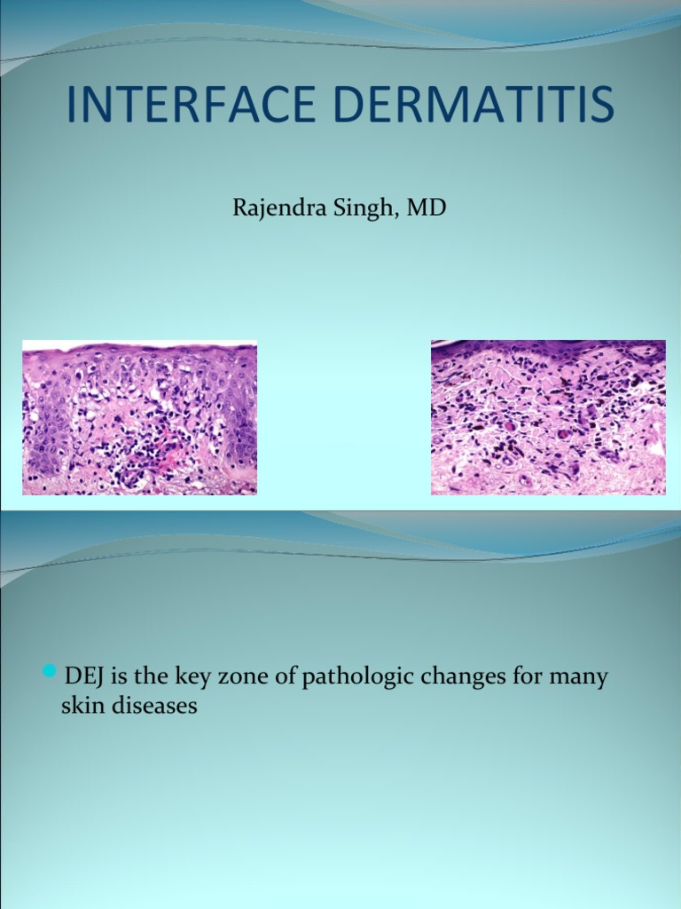 Interface Dermatitis: Rajendra Singh, MD | PDF | Systemic Lupus ...