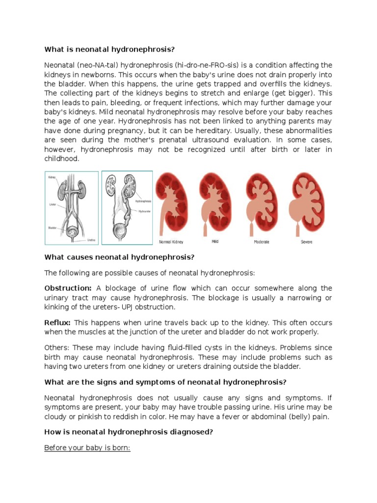 Hydronephrosis PDF Urology Urinary System