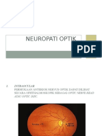 Neuropati Optik (Ika)